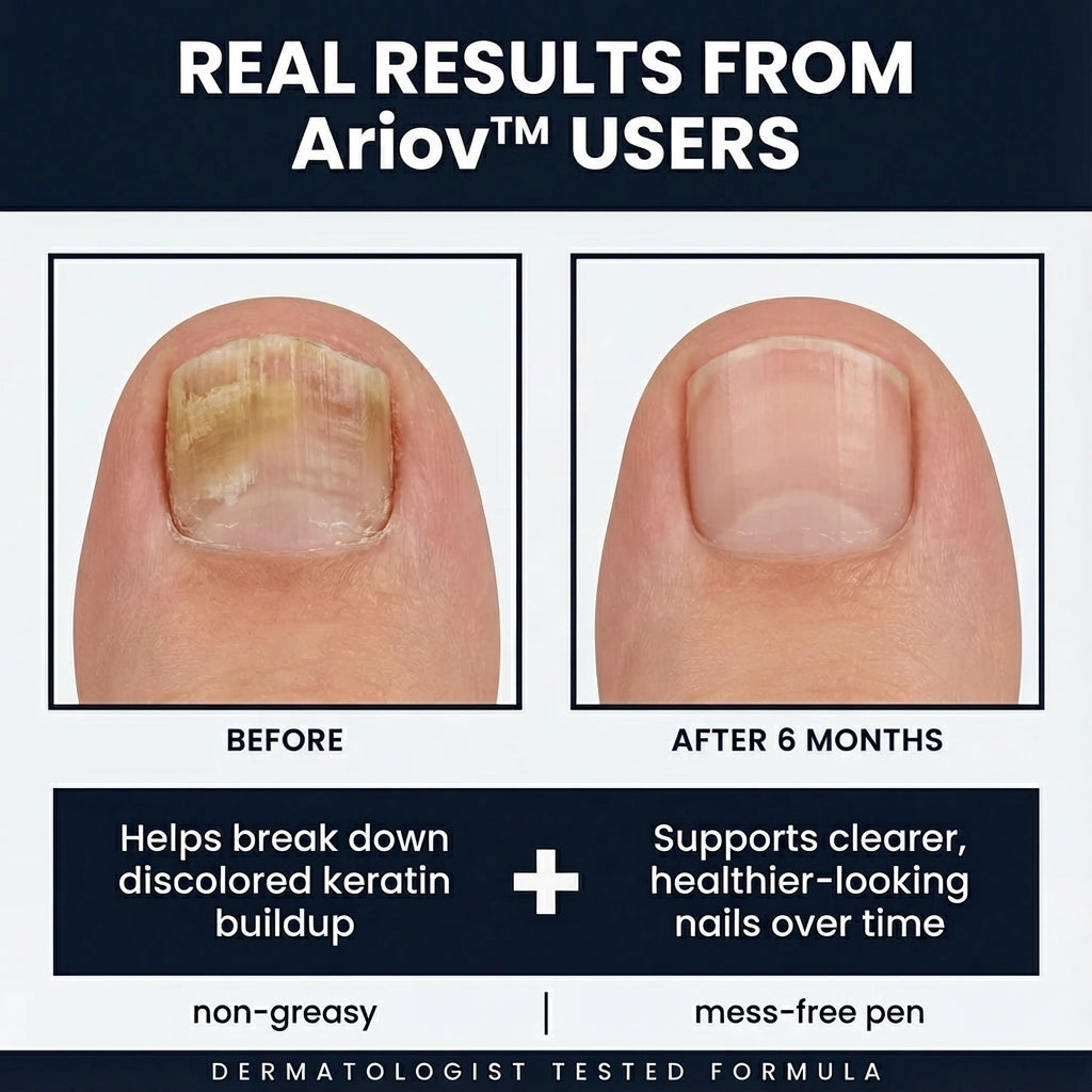 MycoClear™ Anti-Fungal Pen - 25% Undecylenic Acid Ariov™