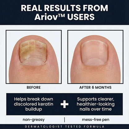 MycoClear™ Anti-Fungal Pen - 25% Undecylenic Acid Ariov™