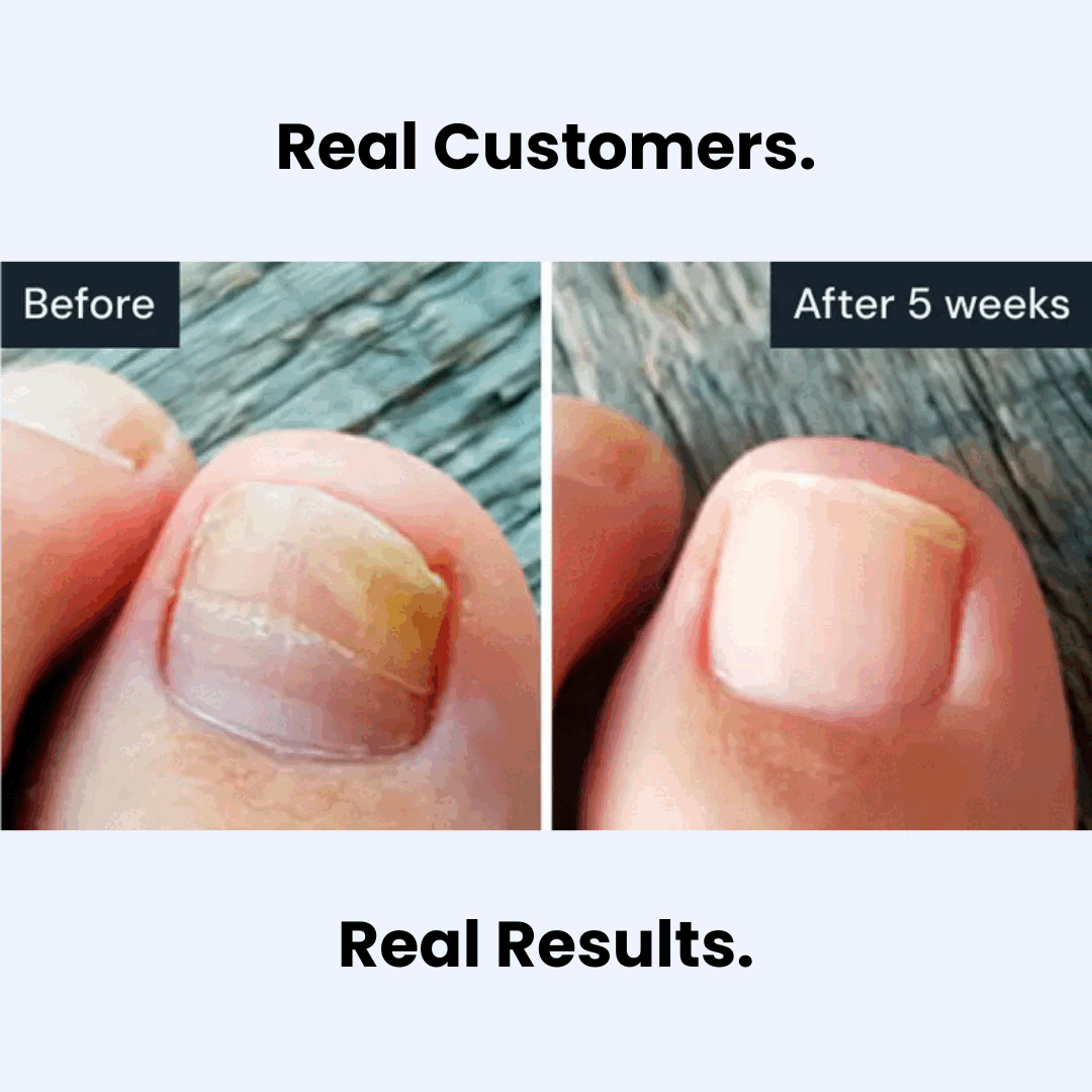 Nuvira™ Antifungal Pen Ariov™