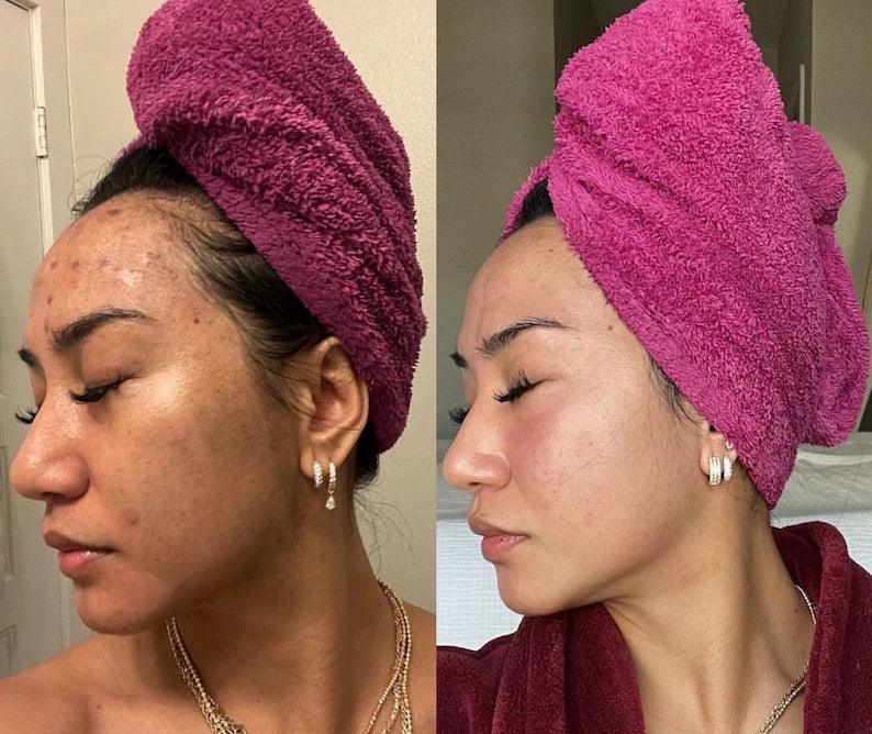 JIYU Toner Pads - Korean Toner Pads Review - Before & After